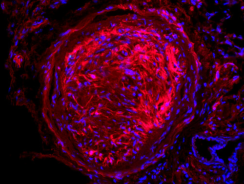 Glaucoma optic nerve