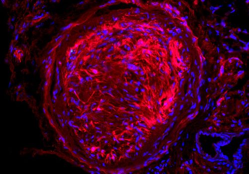 Glaucoma optic nerve