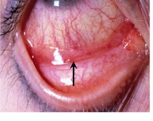 Symptoms of allergic eye disease