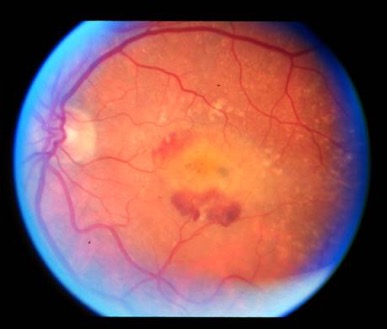 Wet Macular Degeneration