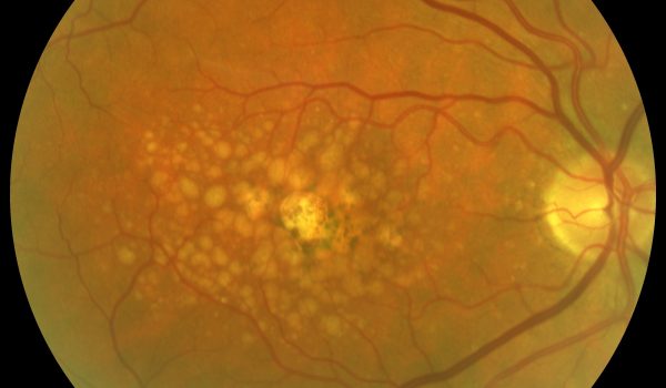 Macular degeneration image