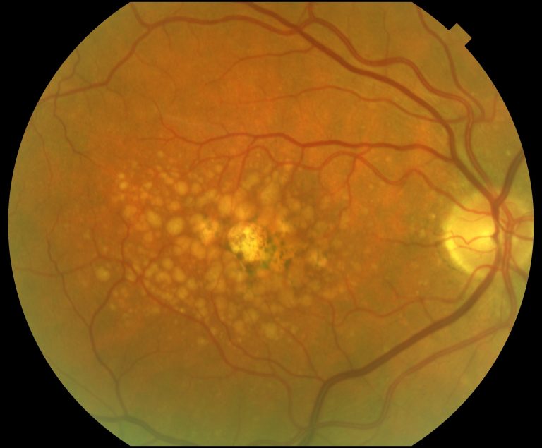 Macular degeneration image