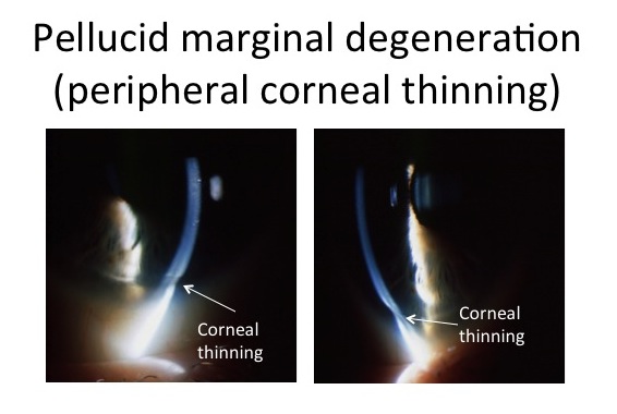 pellucid marginal degneration